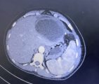 Володимир Поцелуєв робить ставку на сучасну хірургію: у Сумах успішно прооперували гігантську кісту печінки Володимир Поцелуєв робить ставку на сучасну хірургію: у Сумах успішно прооперували гігантську кісту печінки